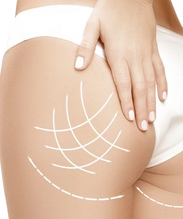 Augmentation fesses par implants en Tunisie