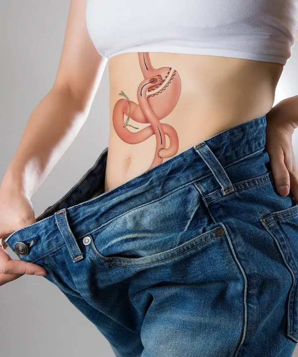 Bypass Gastrique en Tunisie