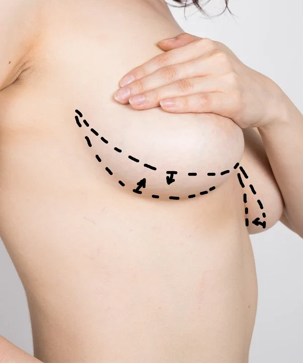 Lipofilling mammaire en Tunisie : pour qui ?